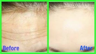 How to Remove Wrinkles from Face & Forehead naturally || Home Remedy