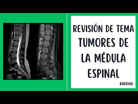 Revisión de Tema 5: Tumores de la Médula Espinal: Aproximación Diagnóstica por Imágenes.