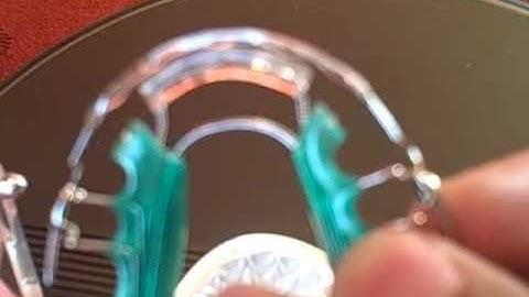 Six Month Braces, Inman Aligner, Conventional Braces