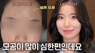 레이저 시술만 16번 했는데 모공이 줄어들지 않아요.. 메이크업으로는 모공 커버가 될까요?