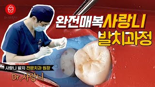 완전 매복사랑니 발치 과정!! 사랑니는 이렇게 뺍니다.