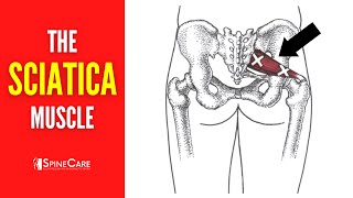 The Sciatica Muscle How To Release It For Instant Relief