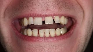 how to get rid of gaps in your teeth without braces fast