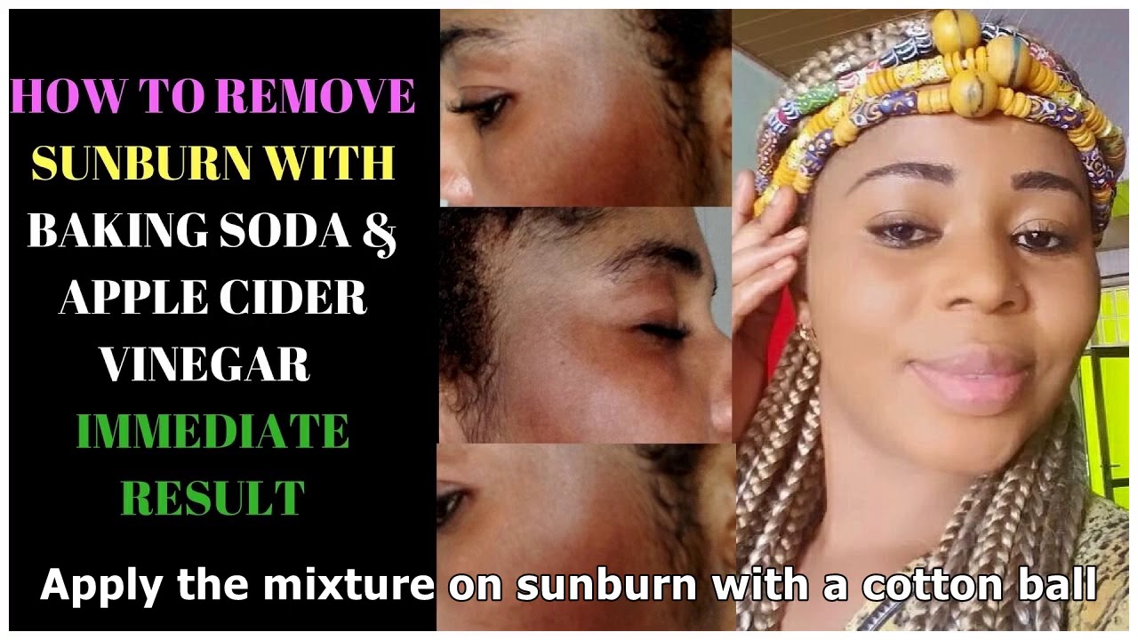 How To Treat Sunburn With Baking Soda 9 Methods Youtube