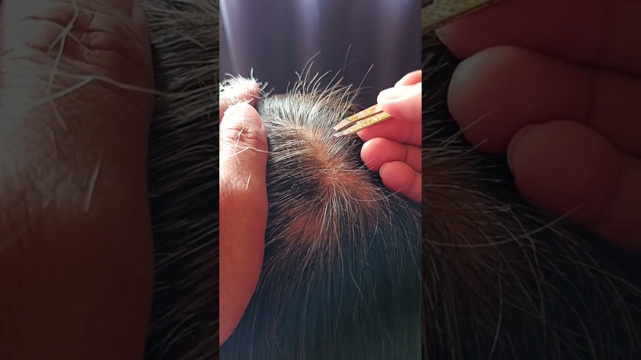 Most satisfying white hair removal 1.26#relaxing #satisfying #stressremoval 