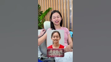 Cùng nghe Lan Phương chia sẻ về quá trình niềng răng của mình tại nha khoa Vinalign nhé #vinalign