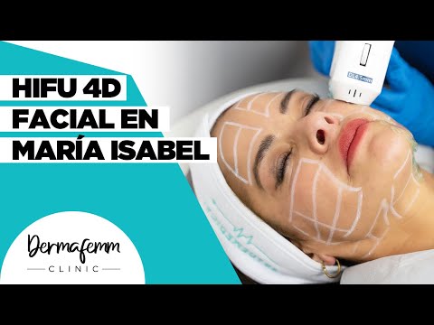 APLICACIÓN DE HIFU 4D FACIAL - En nuestra amiga María Isabel Indo