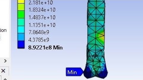 Biomechanal FEA Simulation of Femur bone of human Knee joint by Solidworks and ANSYS