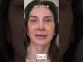 INSANE 2 Week Facelift Healing And Recovery Process 