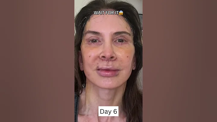 INSANE 2-Week Facelift Healing and Recovery Process!