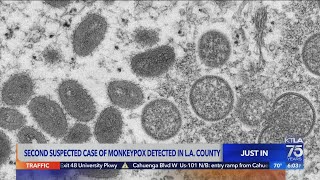 L.A. County confirms 2nd presumptive case of monkeypox
