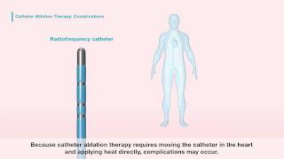 Catheter ablation for atrial fibrillation