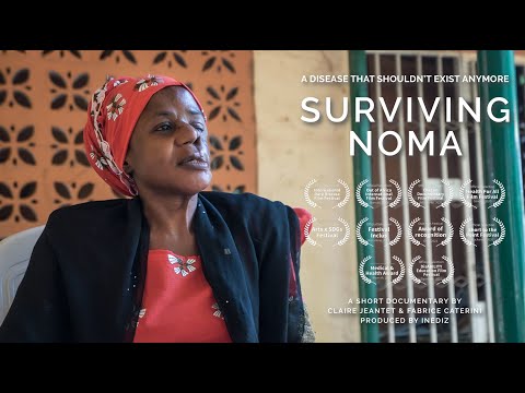 Surviving noma - Official Selection - Health for All Film Festival