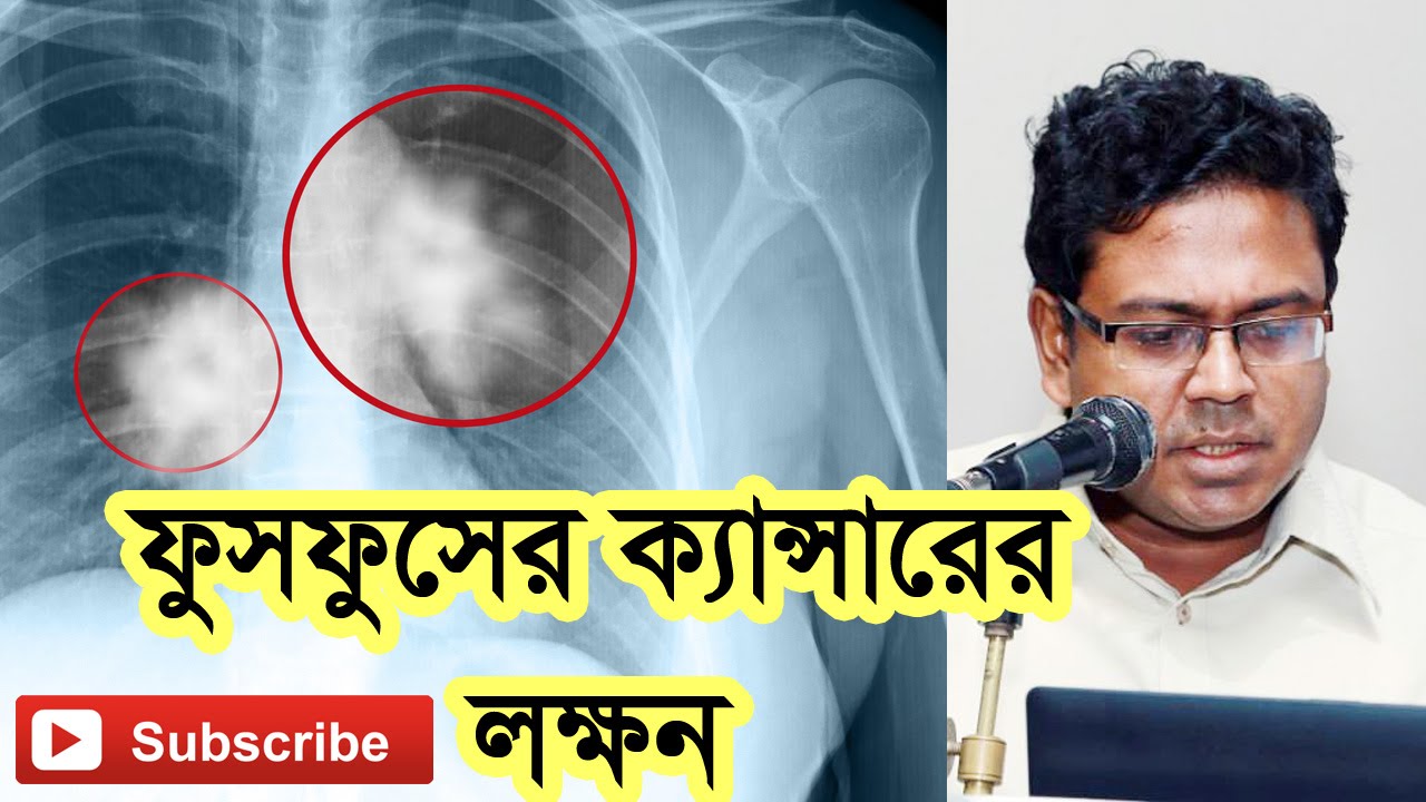 ফুসফুসের ক্যান্সারের লক্ষণ: এই ১০টি লক্ষণ অবহেলা করলেই বিপদ | Symptoms of Lung Cancer.