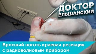 Вросший ноготь краевая резекция с применением радиоволнового прибора