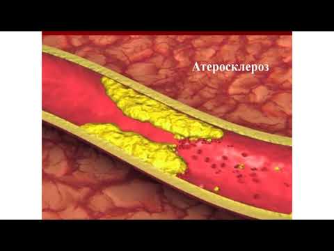 Школа здоровья по дислипидемии.  Занятие  1 "Что такое дислипидемия?"