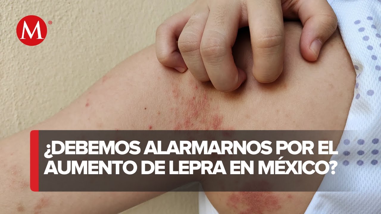No hay que alarmarse, la lepra no se transmite con facilidad: Alejandro ...