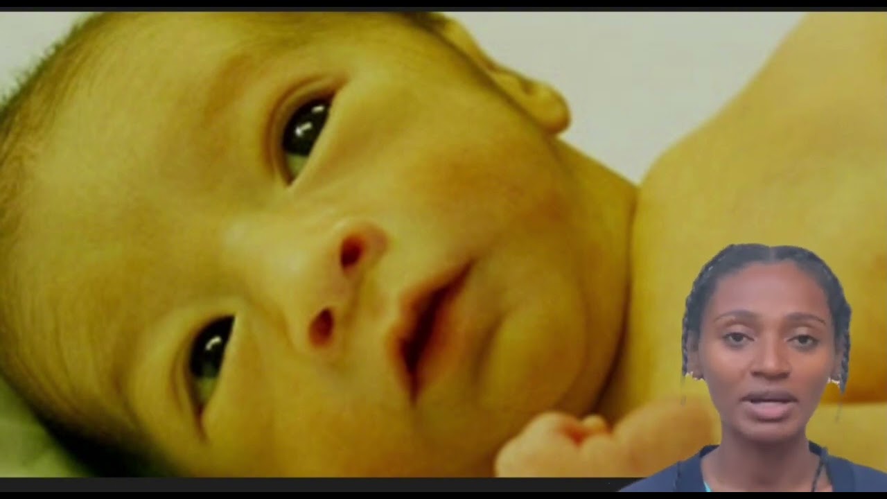 Neontal Jaundice/የጨቅላ ህፃናት ቢጫነት #Neonatal#jaundice#ጨቅላህፃናት#ልጆች#NICU #new @dumenicus#yayaneonatalpage