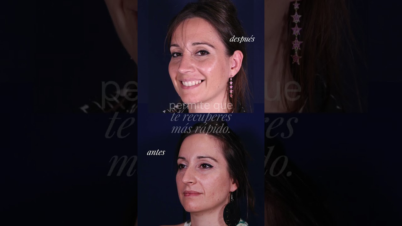 Testimonio de la paciente un año después de su rinoplastia