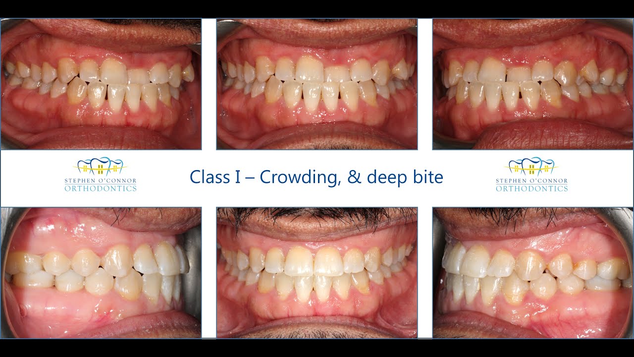 Class III occlusion - Labial ceramic braces - YouTube