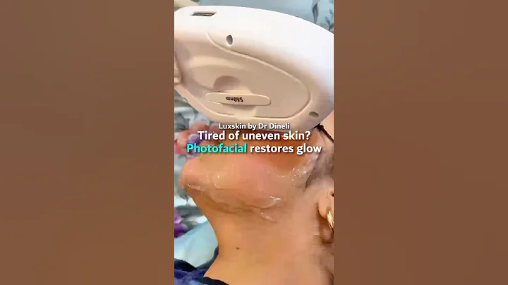 Banish sunspots, redness & pigmentation with Photofacial IPL ✨👌 #photofacial #iplphotofacial