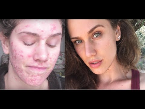 How I Cleared My Cystic Acne By Balancing Hormones, Stress and Mental Health