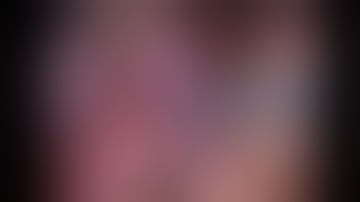 Laparoscopic Fundoplication by Dr Hitesh Chavda, Ahmedabad