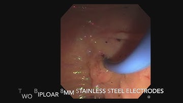 RFA neoadjuvant treatment of Cholangiocarcinoma