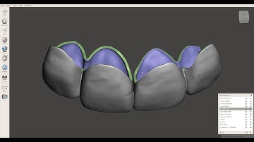 Meshmixer - Provisional Crown Shells