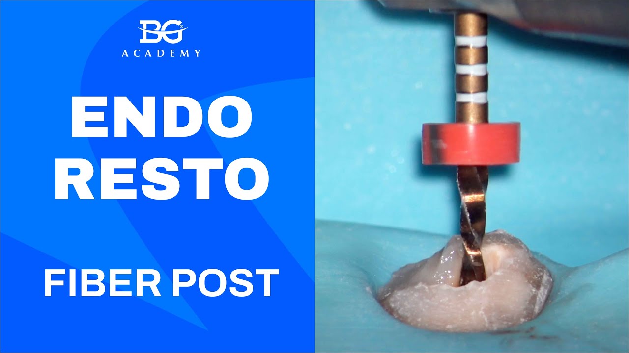 Endo-Resto. Fiber post