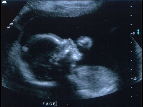 21 Semaines De Grossesse FĆtus Et Echographie Morphologique Youtube 21 Semaines De Grossesse FĆtus Et Echographie Morphologique Youtube