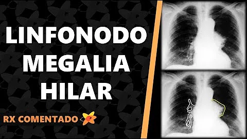 O que é massa hilar?