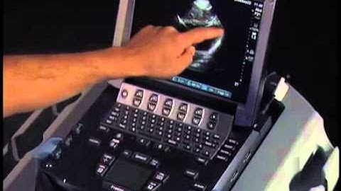 How to: Echocardiography - Subcostal View