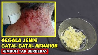 SUPER AMPUH!  CARA MENGOBATI GATAL-GATAL PADA KULIT SECARA CEPAT DAN MUDAH | GERAI SEHAT