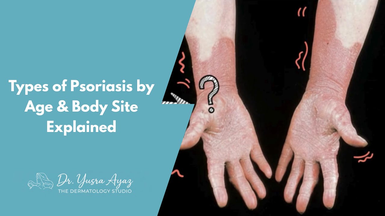 Lecture 3: Types of Psoriasis by Age & Body Site Explained