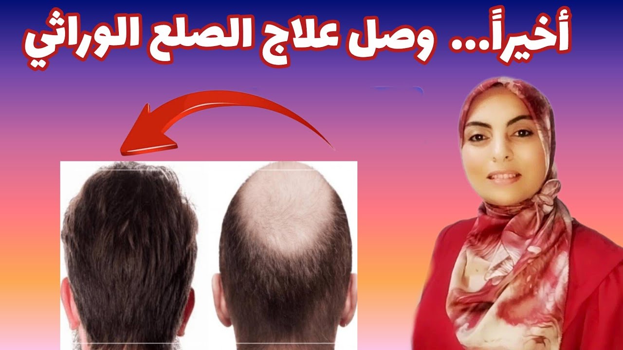 أخيرا ....علاج الصلع الوراثي بمواد طبيعية