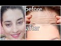 Face Massage for Forehead Wrinkles|Tips, Skincare, Face Exercises Treatment| Rachna Jintaa
