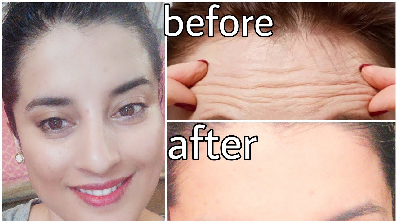 Face Massage for Forehead WrinklesTips, Skincare, Face Exercises
