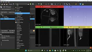 Masking segmentation with grayscale image - 3D Slicer Tutorial