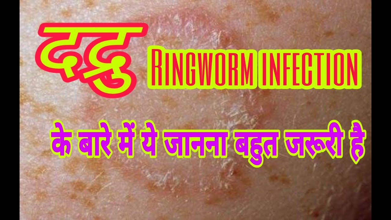 Ayurveda treatment of Ringworm infection दद्रु YouTube