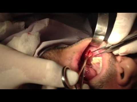Turboslim el té en las farmacias