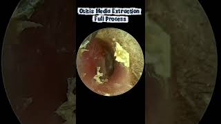 Otitis Media Extraction Full Process