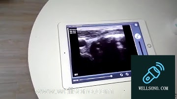 Wireless Portable Ultrasound Mini Scanner Linear Array Probe EXAMINATION