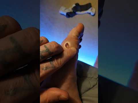 Road rash healing yellow
