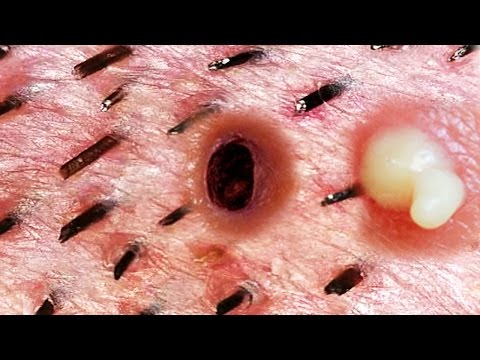 Pimple Popper&#;s Blackheads & Zits Under the Microscope Preview