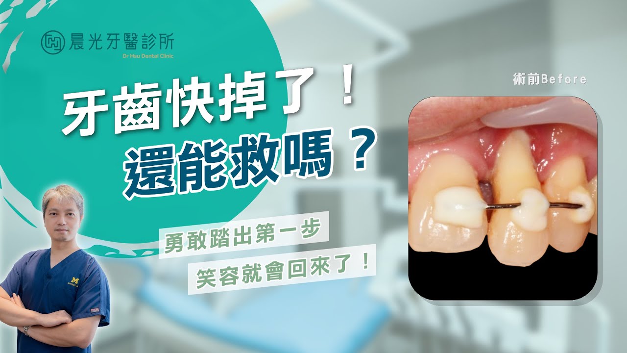 重拾自然笑容的勇氣|徐振祥醫師植牙補骨案例 縮圖