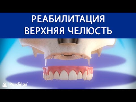 Реабилитация верхняя челюсть с 6 зубные имплантаты ©