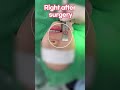 Lip lift surgery #shorts