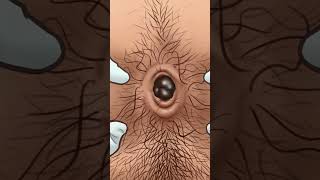 ASMR Dirt and stone removal in deep belly button| Remove Huge Navel Stone Animation Resimi