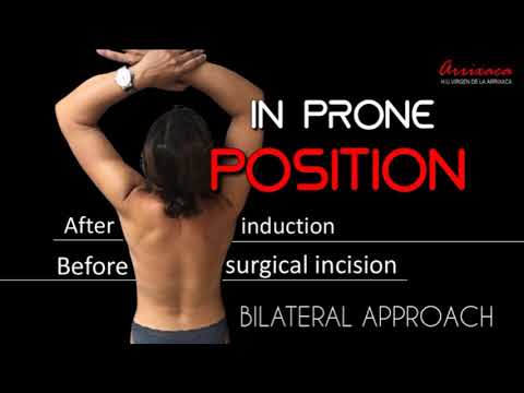 Video: Is erector spinae 'n spier?